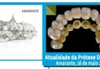 Facetas não partem? Mito ou Realidade? A resposta vai ser dada em Amarante