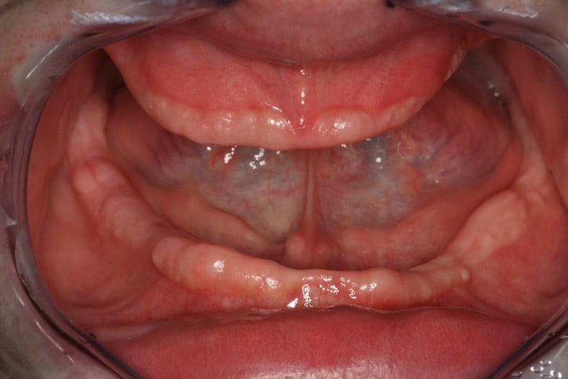 FIG Fotografia intra oral  meses apos a realizacao das exodontias