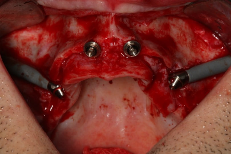 FIG Fotografia intra oral apos colocacao dos implantes na maxila