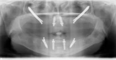FIG Ortopantomografia pos operatoria