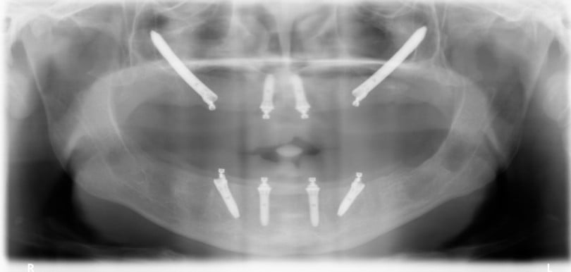 FIG Ortopantomografia pos operatoria