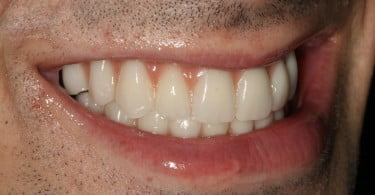 FIG Fotografia extra oral na consulta de controlo  dias após cirurgia