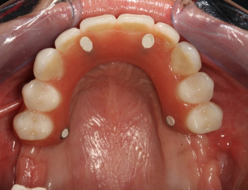FIG Fotografia intra oral na consulta de controlo  dias após cirurgia