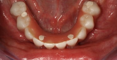 FIG Fotografia intra oral na consulta de controlo  dias após cirurgia