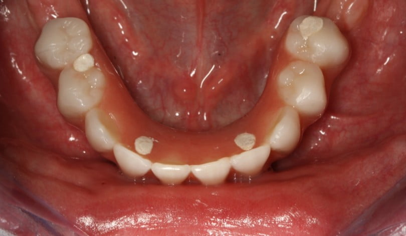 FIG Fotografia intra oral na consulta de controlo  dias após cirurgia