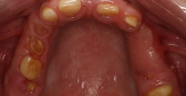 FIG Fotografia oclusal pre operatoria