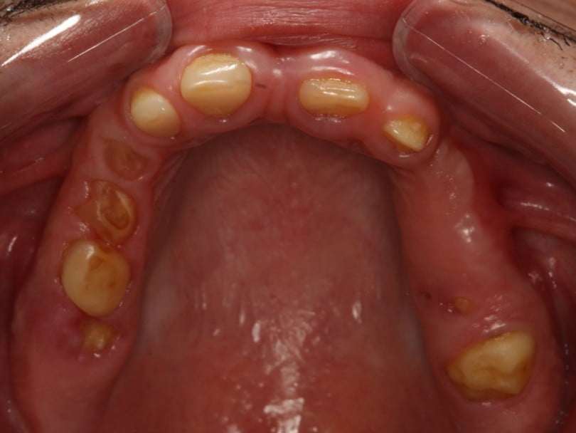 FIG Fotografia oclusal pre operatoria