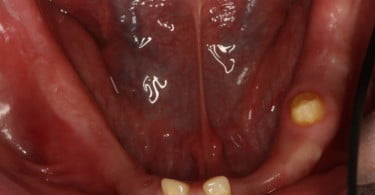 FIG Fotografia oclusal pre operatoria