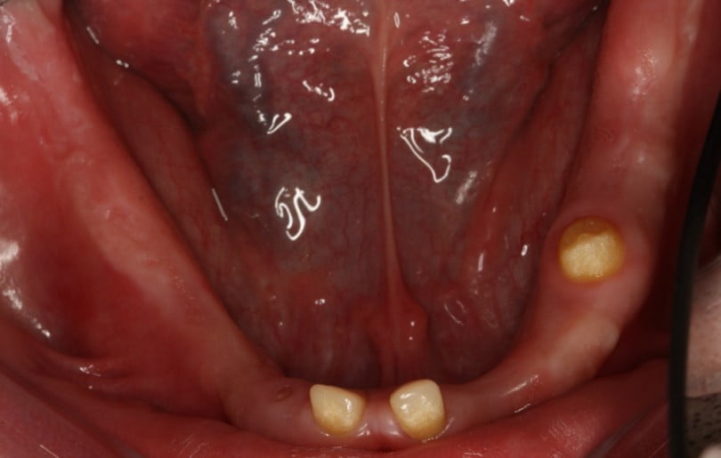 FIG Fotografia oclusal pre operatoria