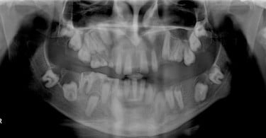 FIG Ortopantomografia inicial