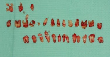 FIG Dentes extraidos