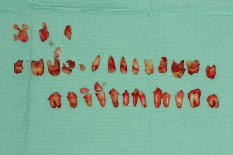 FIG Dentes extraidos