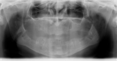 FIG Ortopantomografia  dias apos realizacao das exodontias