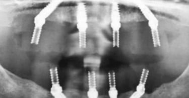 Curso Pós-Graduado de Implantologia e Reabilitação Oral