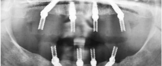 Curso Pós-Graduado de Implantologia e Reabilitação Oral