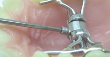 Ortoplus lança novo expansor