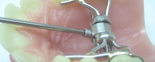 Ortoplus lança novo expansor