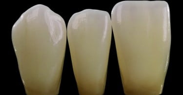 Zirkonzahn lança Prettau Anterior