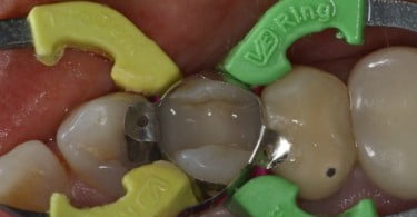 Sistema V3-Ring da Triodent premiado em 2011