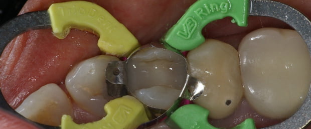 Sistema V3-Ring da Triodent premiado em 2011