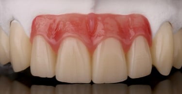 Zirkonzahn com resinas fotopolimerizáveis para recobrimento gengival