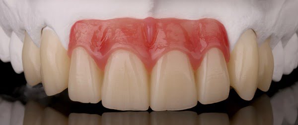 Zirkonzahn com resinas fotopolimerizáveis para recobrimento gengival