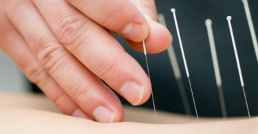 Acupuntura pode reduzir reflexos de vómito em pacientes dentários