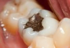 Cientistas estudam novo material para substituir amálgama dentária