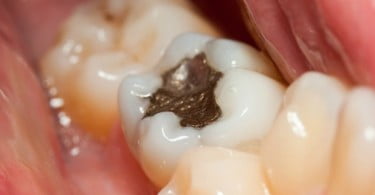 Cientistas estudam novo material para substituir amálgama dentária