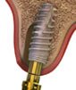 Nobel Biocare lança novo implante dentário