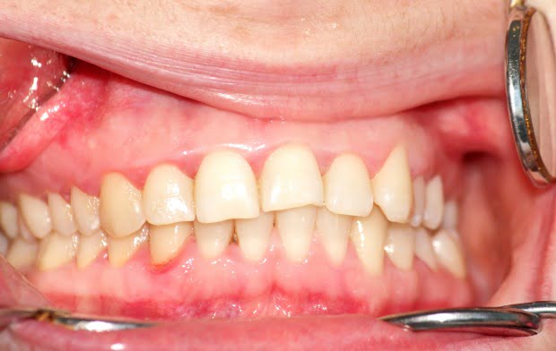 Espanhóis criam nova técnica para detetar carcinomas na mucosa oral