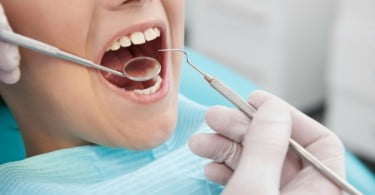 Descoberto novo agente antisséptico para combater periodontite