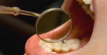 Sensores embutidos nos dentes revelam hábitos de higiene