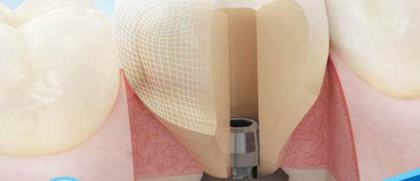 CAD/CAM Atlantis disponível para restaurações unitárias aparafusadas