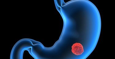 Infeções evitáveis responsáveis por cancro