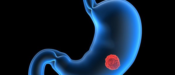 Infeções evitáveis responsáveis por cancro