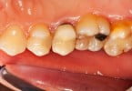 Cientistas chilenos desenvolvem molécula que elimina cáries dentárias