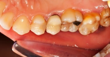 Cientistas chilenos desenvolvem molécula que elimina cáries dentárias