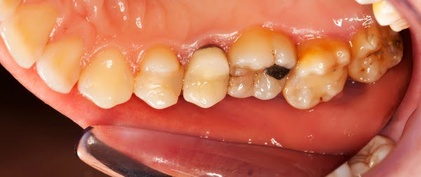 Cientistas chilenos desenvolvem molécula que elimina cáries dentárias
