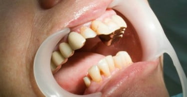 Estudo revela que 35% da população global sofre de cáries