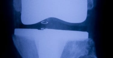 Novo biomaterial desenvolvido para preparação de cartilagem