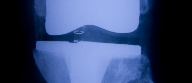 Novo biomaterial desenvolvido para preparação de cartilagem