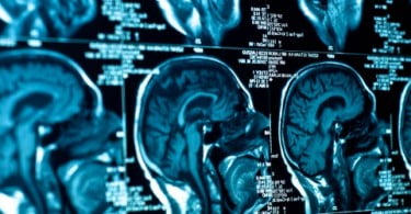 Cientistas conseguem medir dor a partir de imagens do cérebro