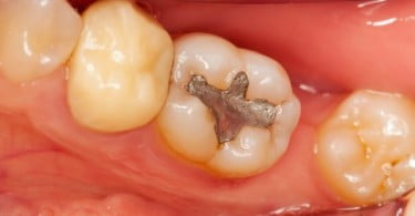 SPEMD afirma segurança do amálgama dentário
