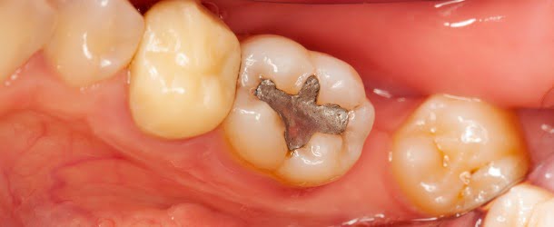 SPEMD afirma segurança do amálgama dentário