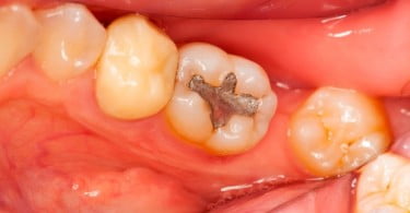 Investigadores estudam efeitos neurológicos da exposição ao mercúrio