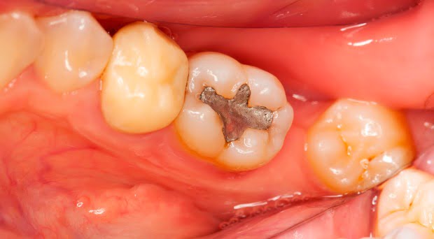 Investigadores estudam efeitos neurológicos da exposição ao mercúrio
