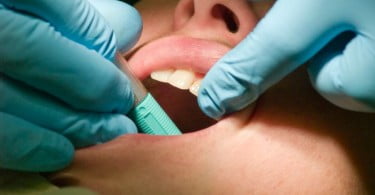 cáries dentárias pessoa a fazer check up