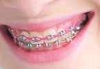 Estudo alerta para micróbios nos aparelhos dentários