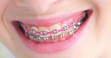 Estudo alerta para micróbios nos aparelhos dentários